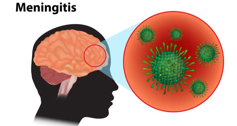 meningitis brain infection