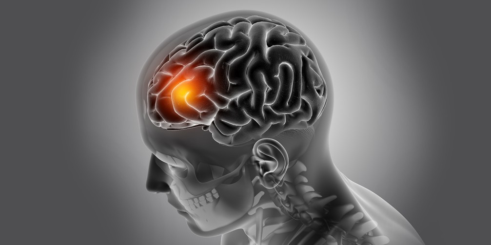 What Do You Need to Know About Brain Tumors?